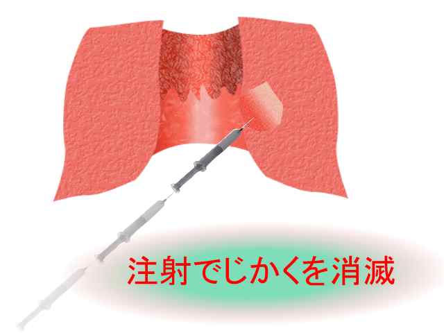 内痔、イボ痔、脱肛(肛門科のサイト、大腸ドットコム)