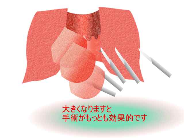 内痔、イボ痔、脱肛(肛門科のサイト、大腸ドットコム)